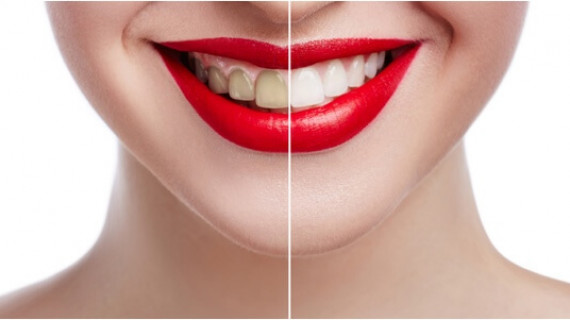 Porcelain Veneers