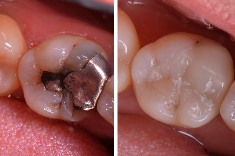 Tooth filling and Restorative