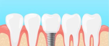 Dentures, Implants, or Both? Which Dental Implant is Best for you