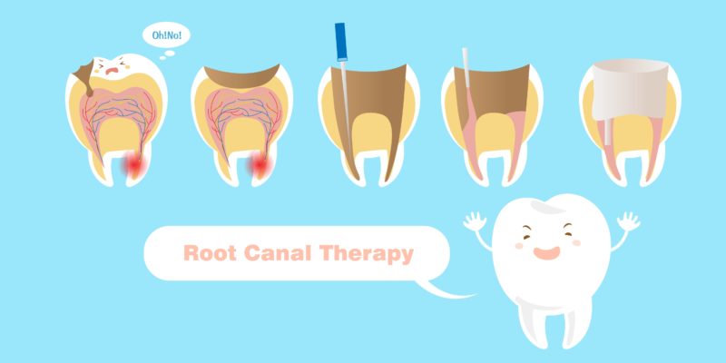 root canal treatment and therapy dentistry on coolum on the sunshine coast