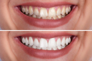 Woman's Teeth Before And After Whitening dentistry on coolum