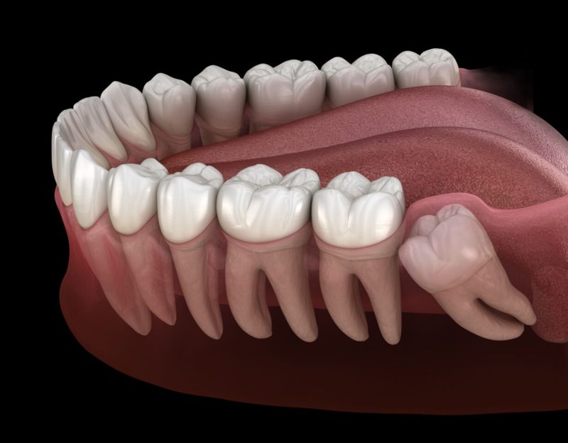 Illustration of an impacted wisdom tooth in the lower jaw