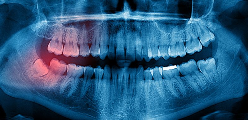 Dental X-ray showing impacted wisdom teeth