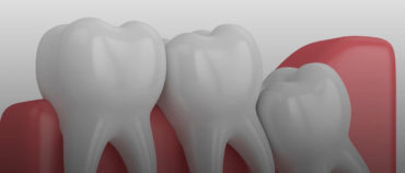 5 Ways To Relieve Wisdom Tooth Pain