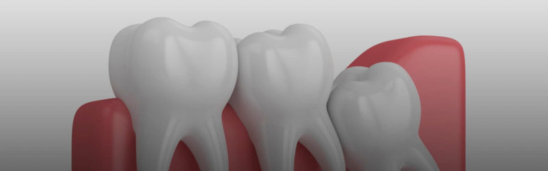 5 Ways To Relieve Wisdom Tooth Pain