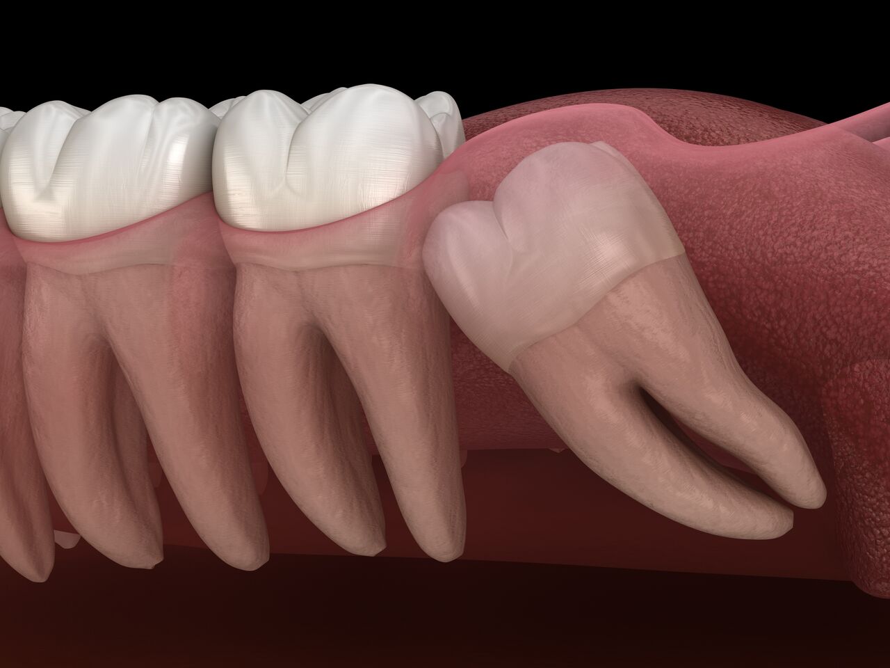 wisdom teeth removal aspendale