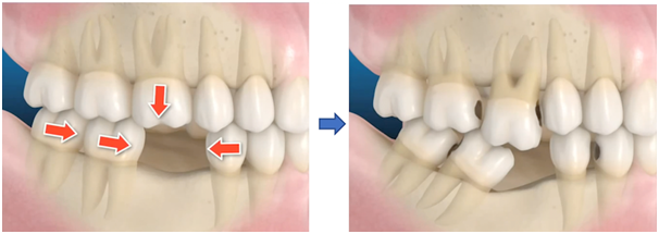 missing teeth