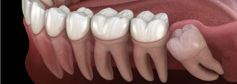 causes of wisdom tooth pain dentistry on coolum