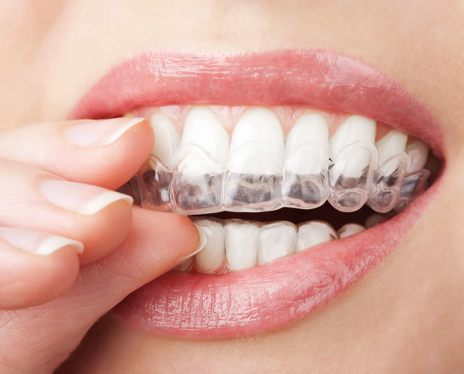 Custom teeth whitening tray being fitted over the teeth