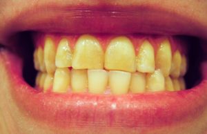 Teeth Grinding image - dentistry on coolum