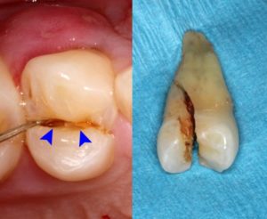 Cracked Tooth Treatment Dentistry On Coolum