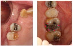 Types of cracked teeth - Dentistry on Coolum