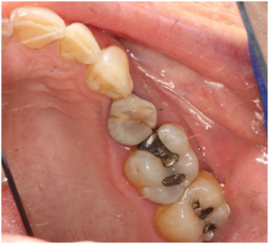 Cracked Tooth Without A Filling - Dentistry on Coolum