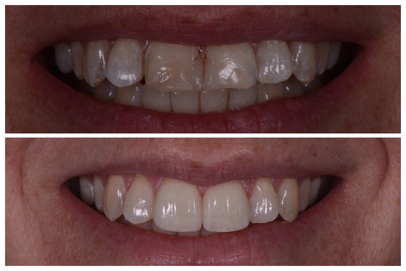 Porcelain Veneers Cosmetic Dentistry