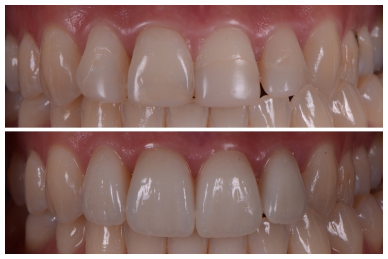 Before and after veneer cosmetic dentistry