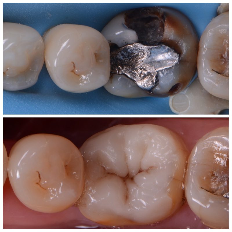 Metal tooth filling vs white teeth filling