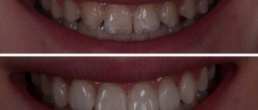 The Process of a Smile Makeover