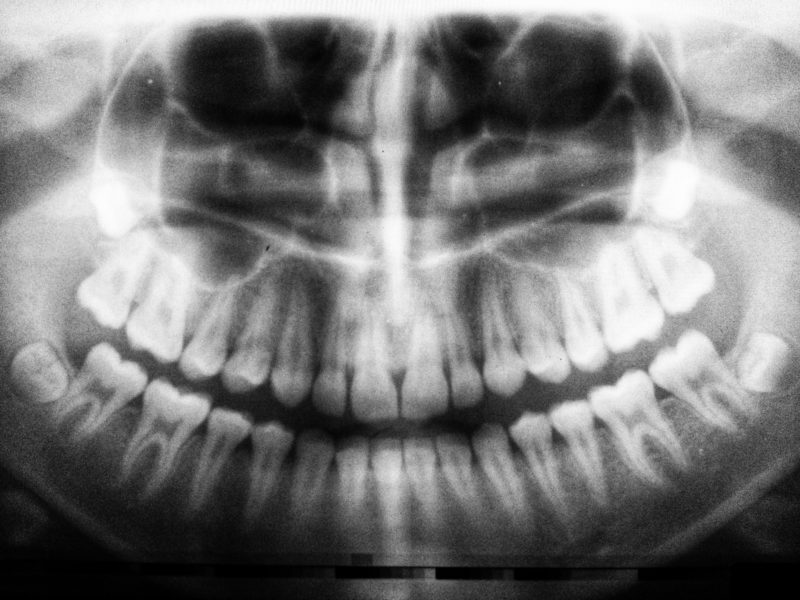 The First Signs Of Wisdom Teeth Coming In