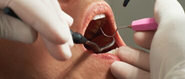 What is a Tooth Filling & How Does it Work?