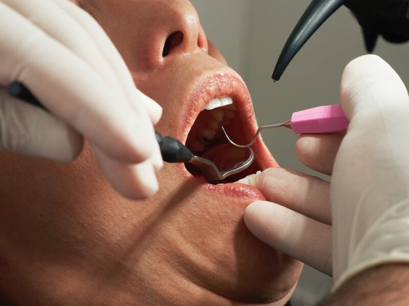 What is a Tooth Filling & How Does it Work?