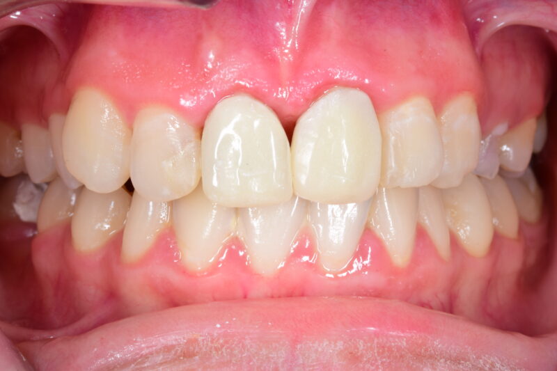 Fixed Prosthetic Crowns In Central Incisors