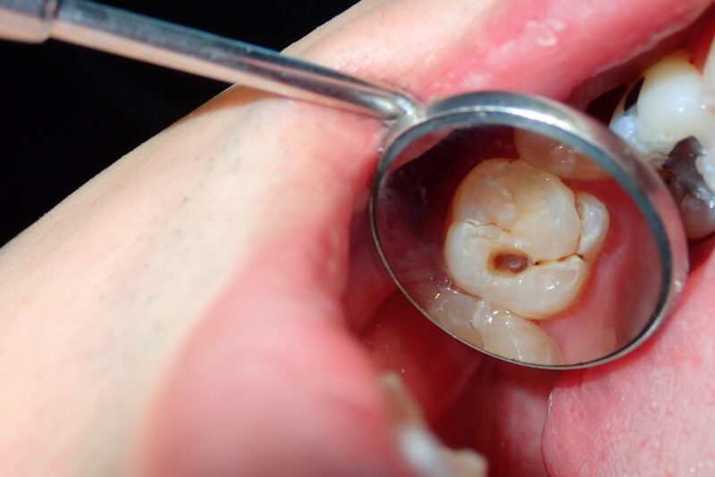 How Long Does a Dental Filling Last?