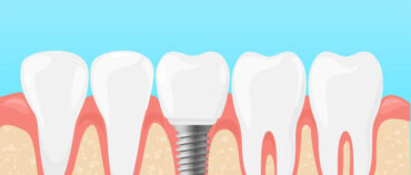 Are Dental Implants Painful?