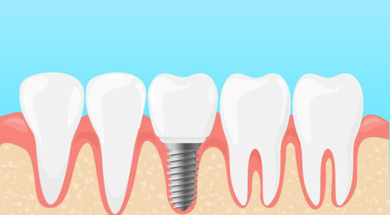 Are Dental Implants Painful?