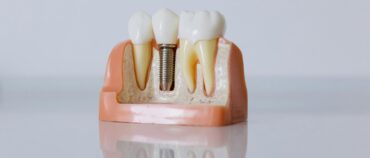 Does Medicare Cover Dental Implants?