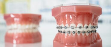 What is The Best Age to Get Braces?