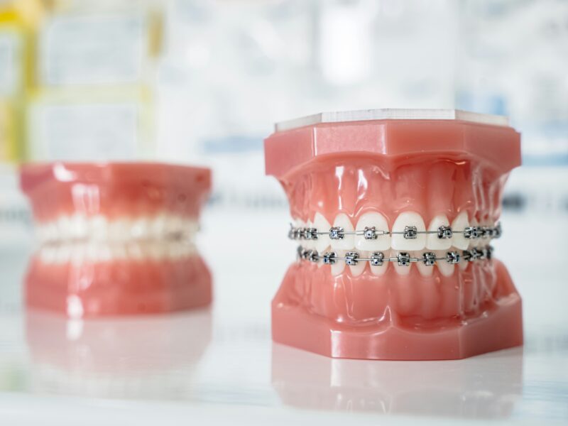 What is The Best Age to Get Braces?