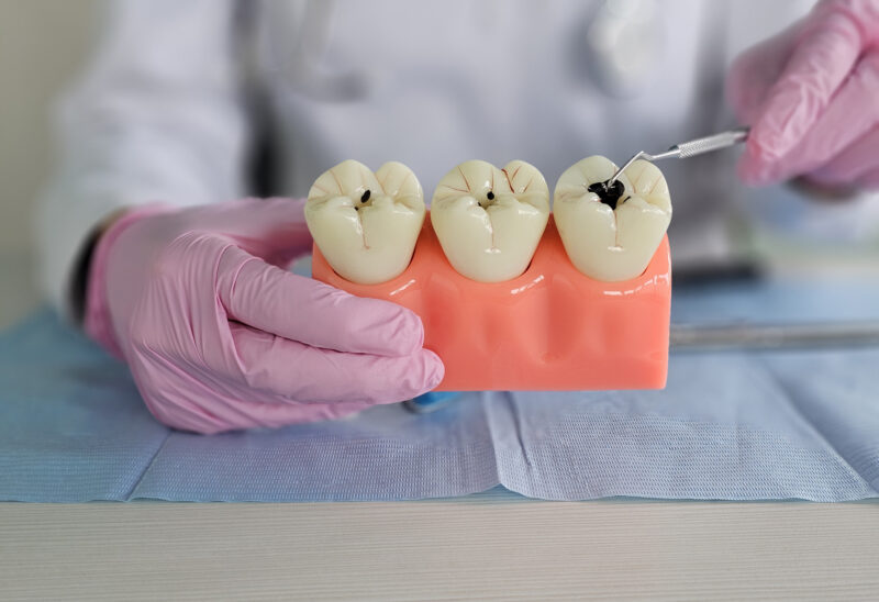 Signs You May Need Tooth Decay Treatment
