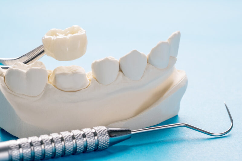 Model of a dental crown being placed on a prepared tooth